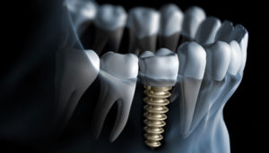 Dental implant 3d illustration 