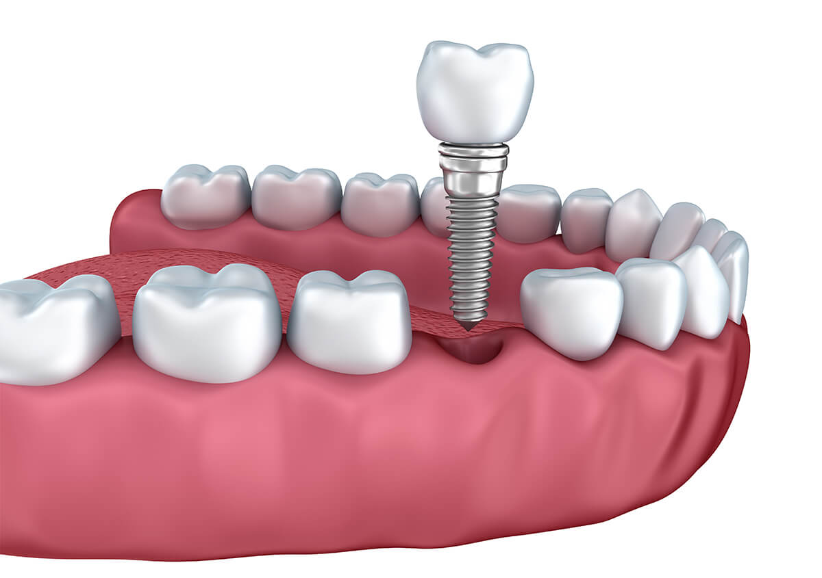 Affordable Dental Implants Near Me Chino Hills CA Area