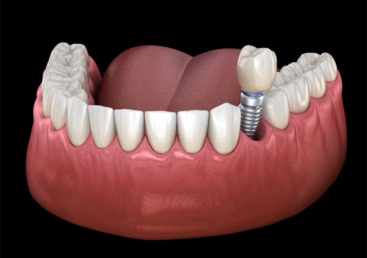 Restorative Dental Implants in Chino Hills CA Area