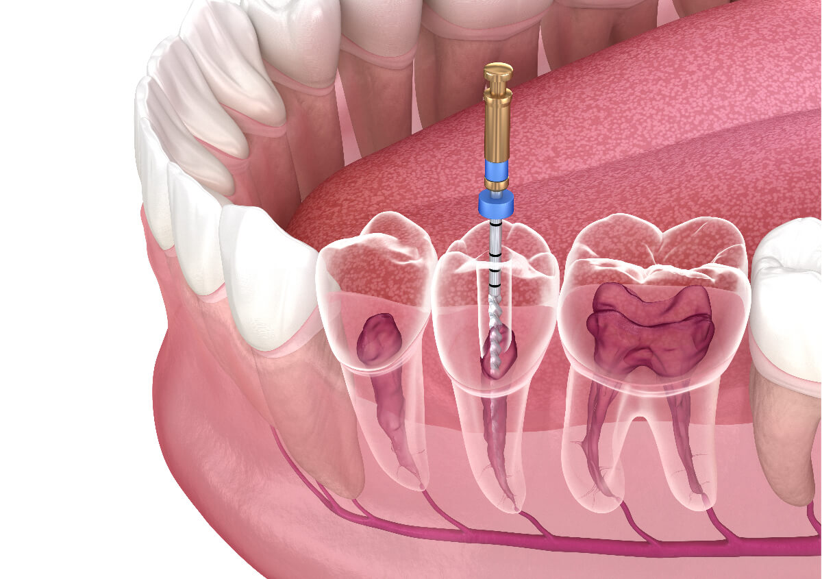 Safe Root Canal Treatment in Chino Hills CA area