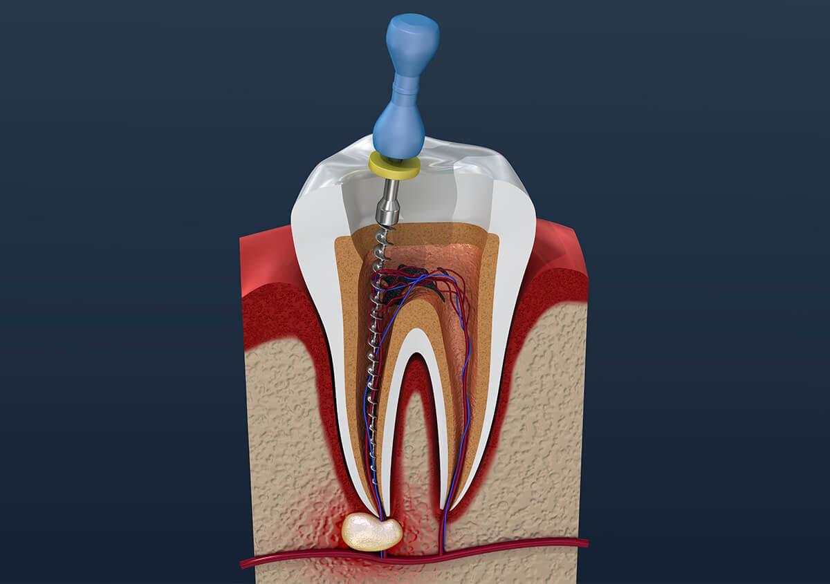 Tooth Root Abscess Treatment in Chino Hills CA Area