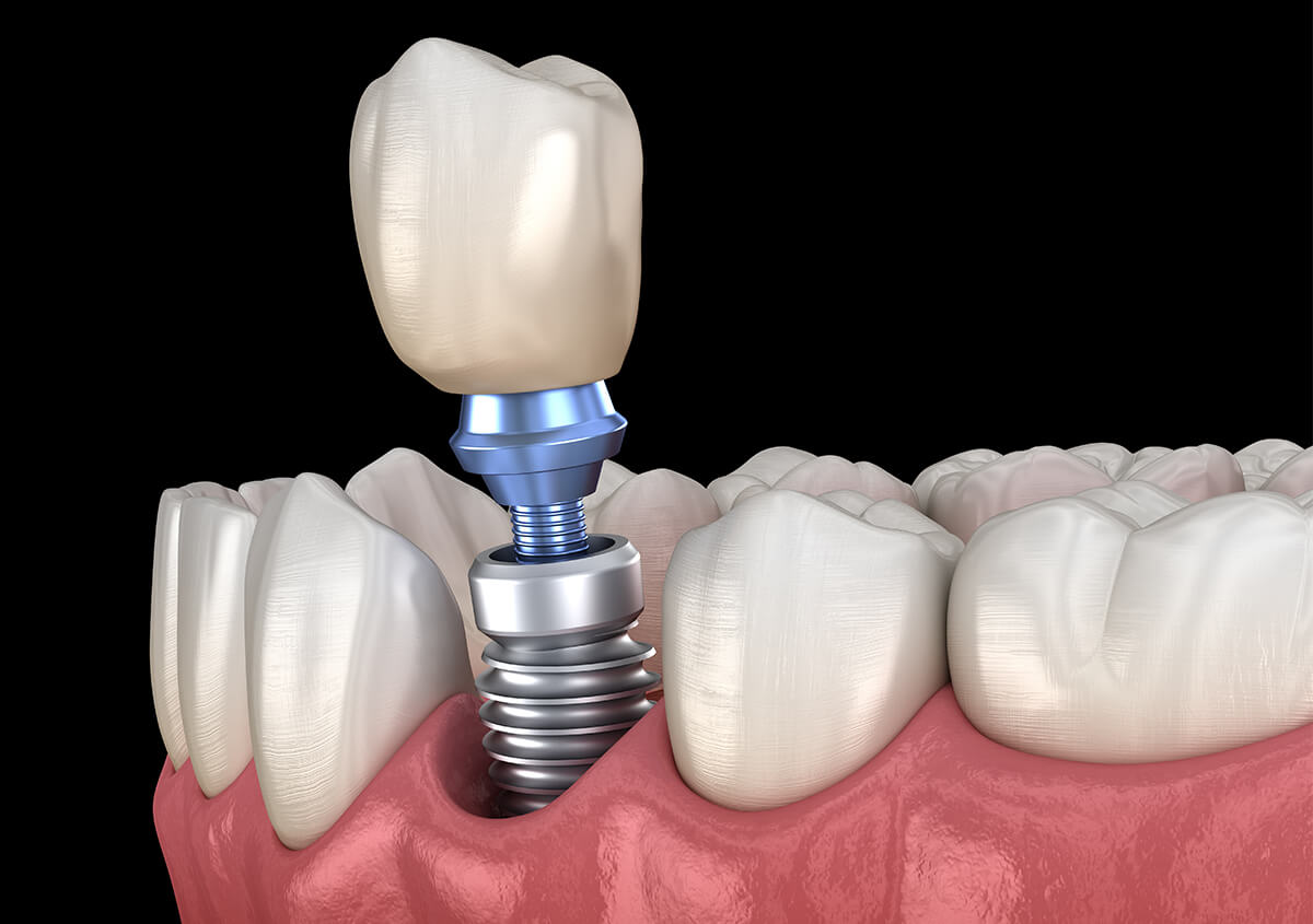 Dental Implants for Missing Teeth in Chino Hills CA Area